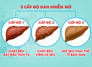 Gan nhiễm mỡ giai đoạn 1 gây nguy hiểm như thế nào? 